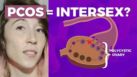 Insulin levels build up in the body and may cause higher androgen levels. . Pcos is not intersex reddit